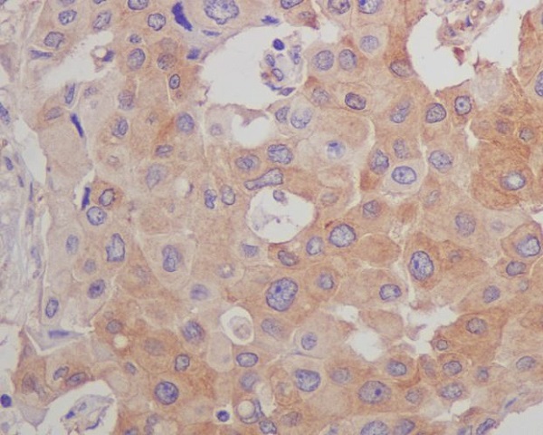 Immunohistochemical analysis of paraffin-embedded human breast carcinoma, using beta Tubulin Mouse Monoclonal Antibody.