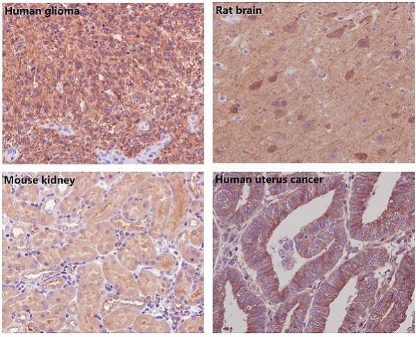 Immunohistochemical analysis of paraffin-embedded (1) Human glioma; (2) Rat brain; (3) Mouse kidney; (4) Human uterus cancer, using beta Tubulin Antibody.