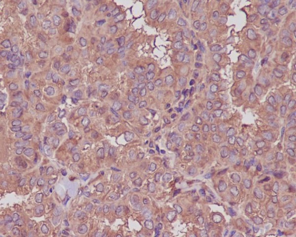 Immunohistochemical analysis of paraffin-embedded human thyroid cancer, using beta III Tubulin Antibody.
