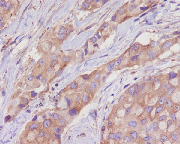 Immunohistochemical analysis of paraffin-embedded human breast cancer, using alpha Tubulin Antibody.